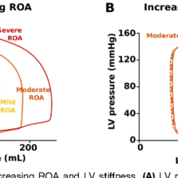 Pressure volume loop aortic regurgitation