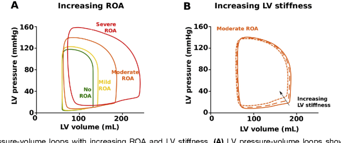 Pressure volume loop aortic regurgitation