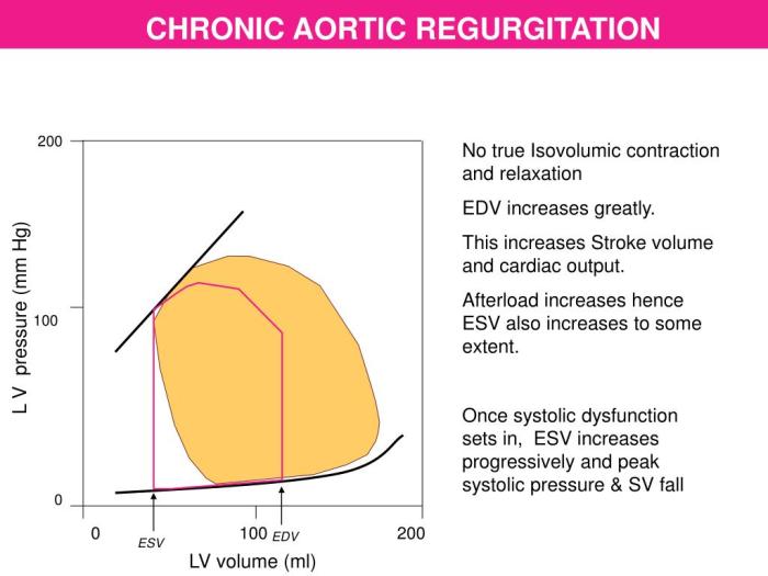 Mitral regurgitation aortic murmurs ventricular ivms icm