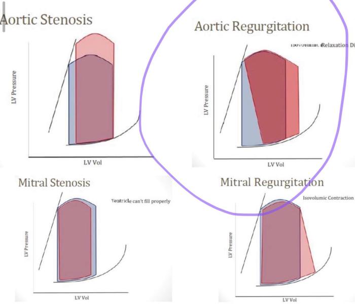 Pressure volume loop aortic regurgitation